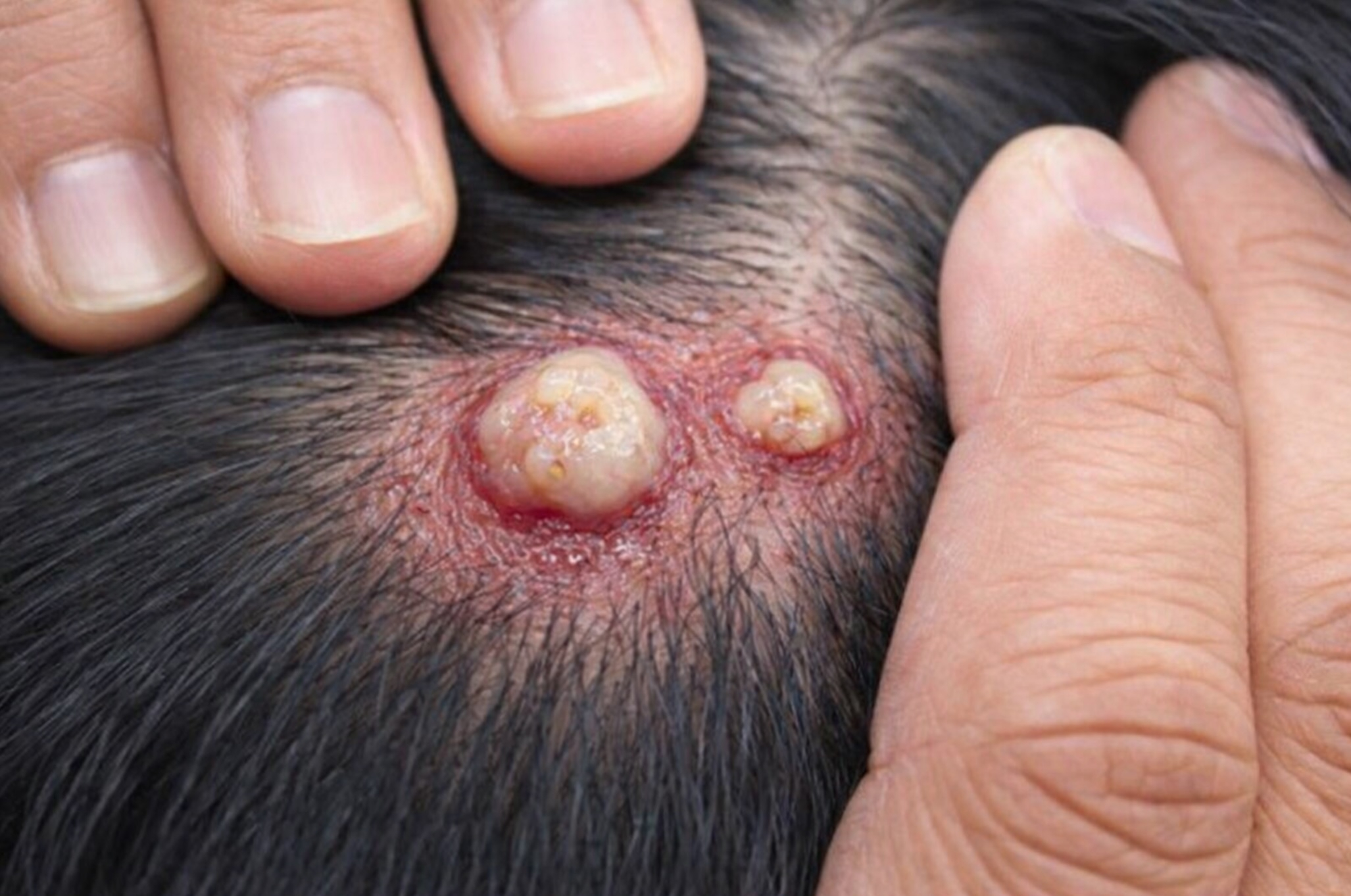 Popping A Sebaceous Cyst - Can I Burst A Sebaceous Cyst At Home ... pertaining to Composite Decking Screws Problems