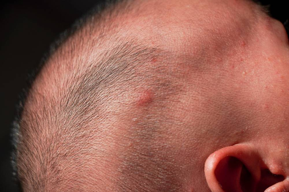 Red Bumps On Scalp Folliculitis pertaining to Stop Head Pop And Mushrooming Before It Ruins Your Outdoor Living Space